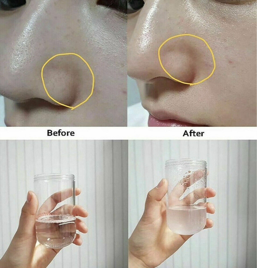 Hidrafacial Aqua Peeling